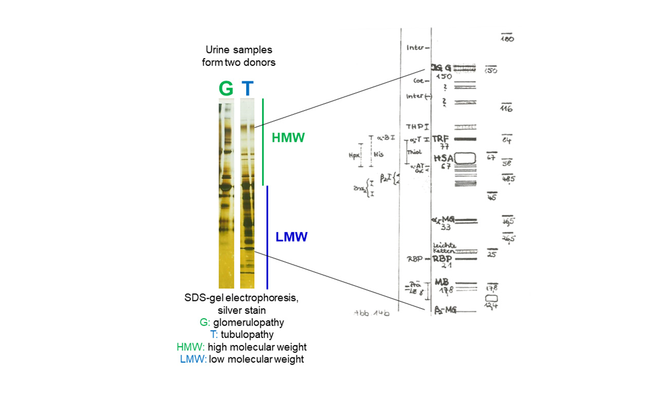 Kidney: Urine Proteins – Proteinuria